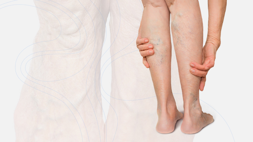 Chronic Venous Insufficiency: Symptoms, Causes, and Treatment