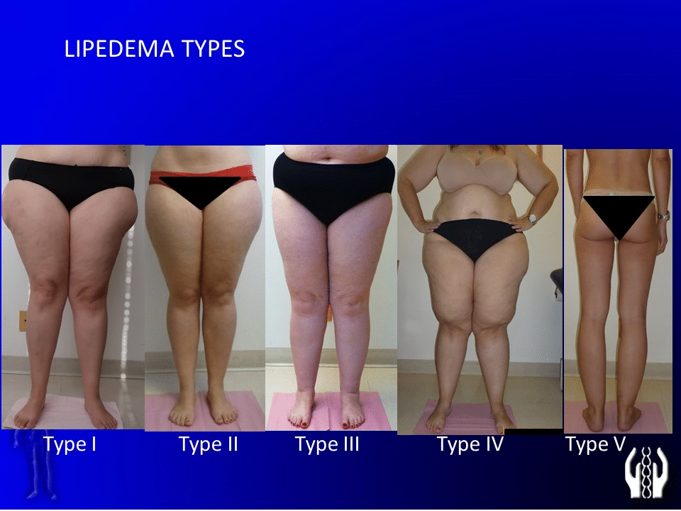 Connection between Lipedema, Obesity & Lymphedema - Lipedema