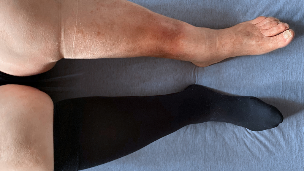 Lymphedema and Compression Stocking