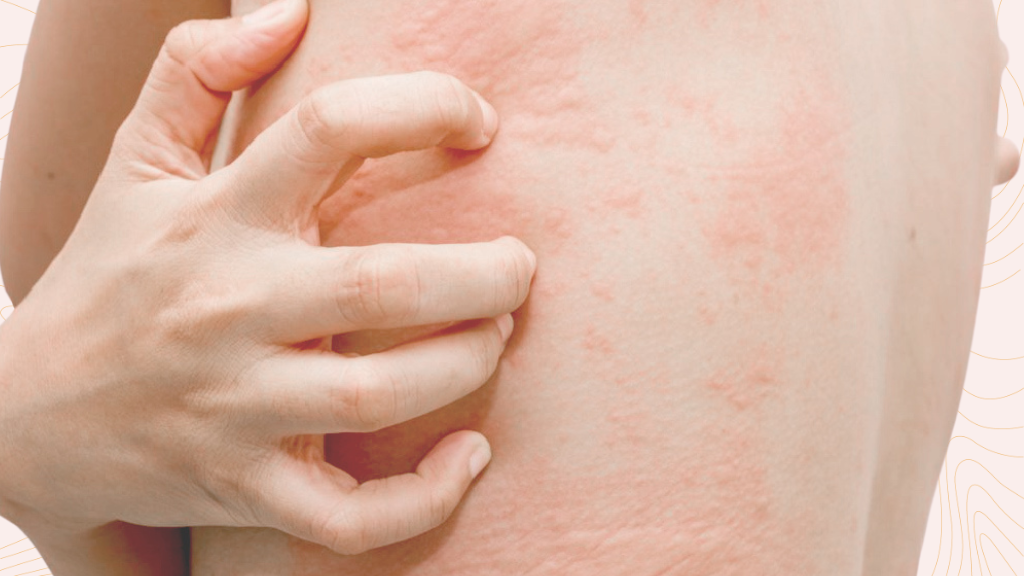 Image of a person scratching red spots on skin